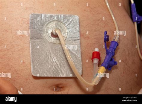 Percutaneous Endoscopic Gastrostomy (PEG) Quick Reference .